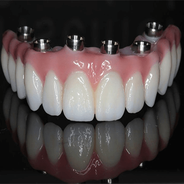 Full Mouth Implant Treatments