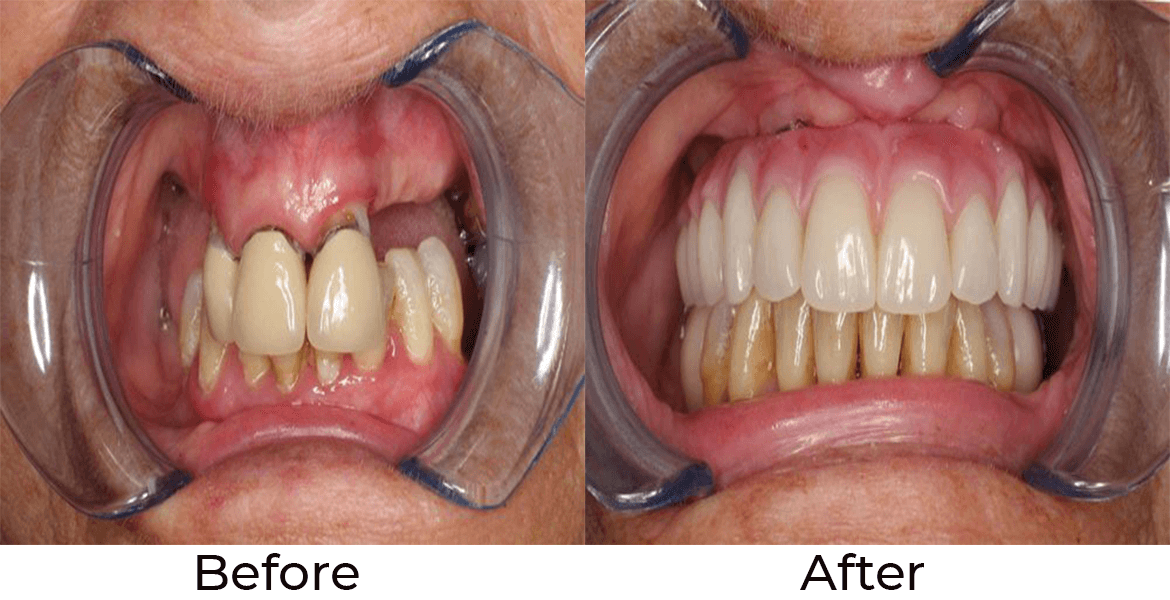 Service Full Arch and Full Mouth Implant Treatments Image