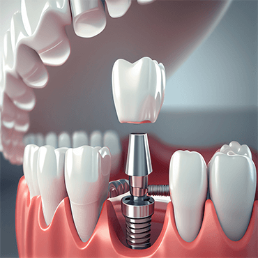 Single and Multiple Tooth Implant Treatments