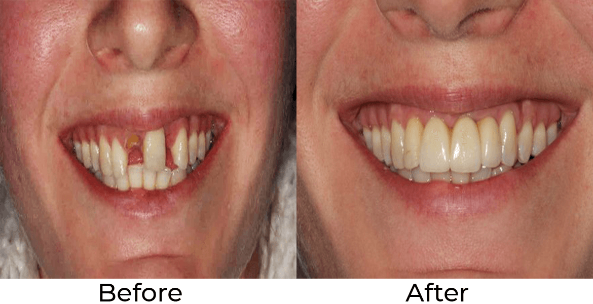 Service Single and Multiple Tooth Implant Treatments Image