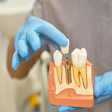 Dental Implants