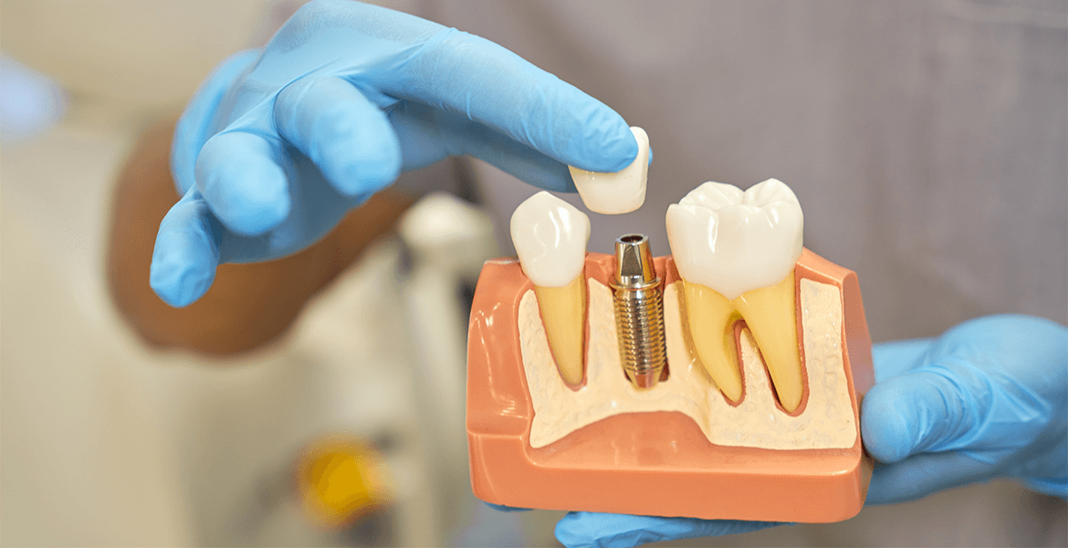 Service Dental Implants Image